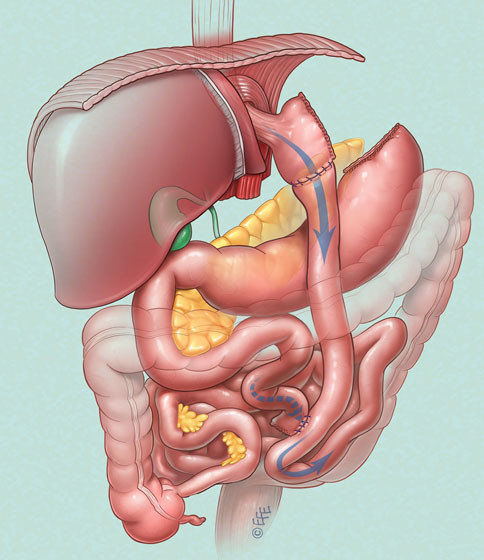 Laparoscopic Gastric Bypass 2