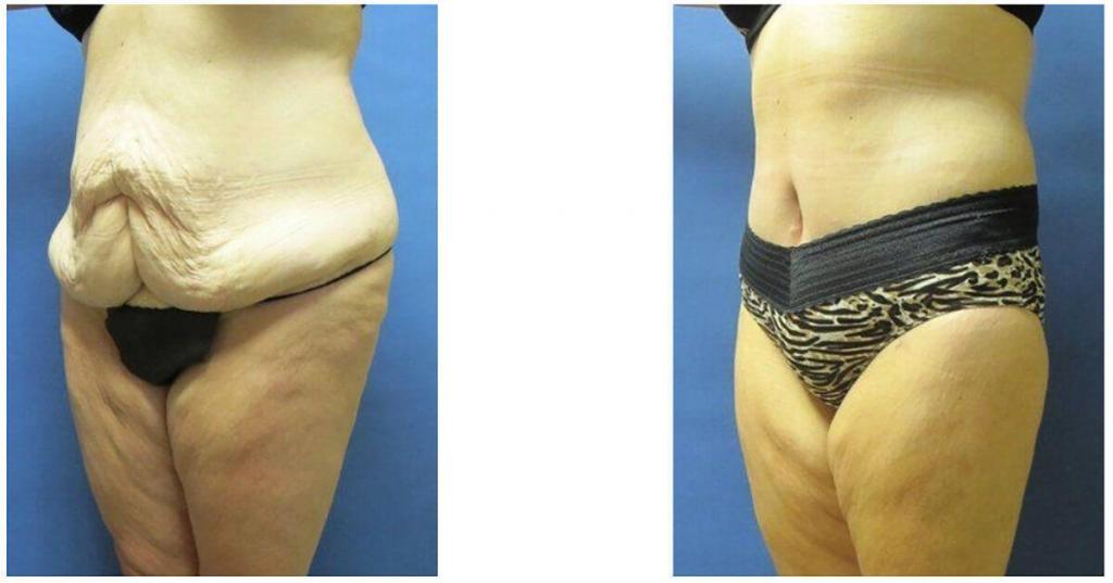 Tummy Tuck Before - After