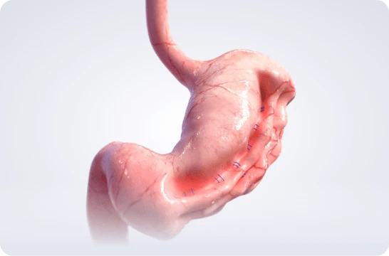 ESG Endoskopik Sleeve Gastroplasti prosedürü