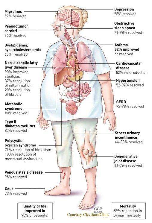 Benefits of Bariatric Surgery 2