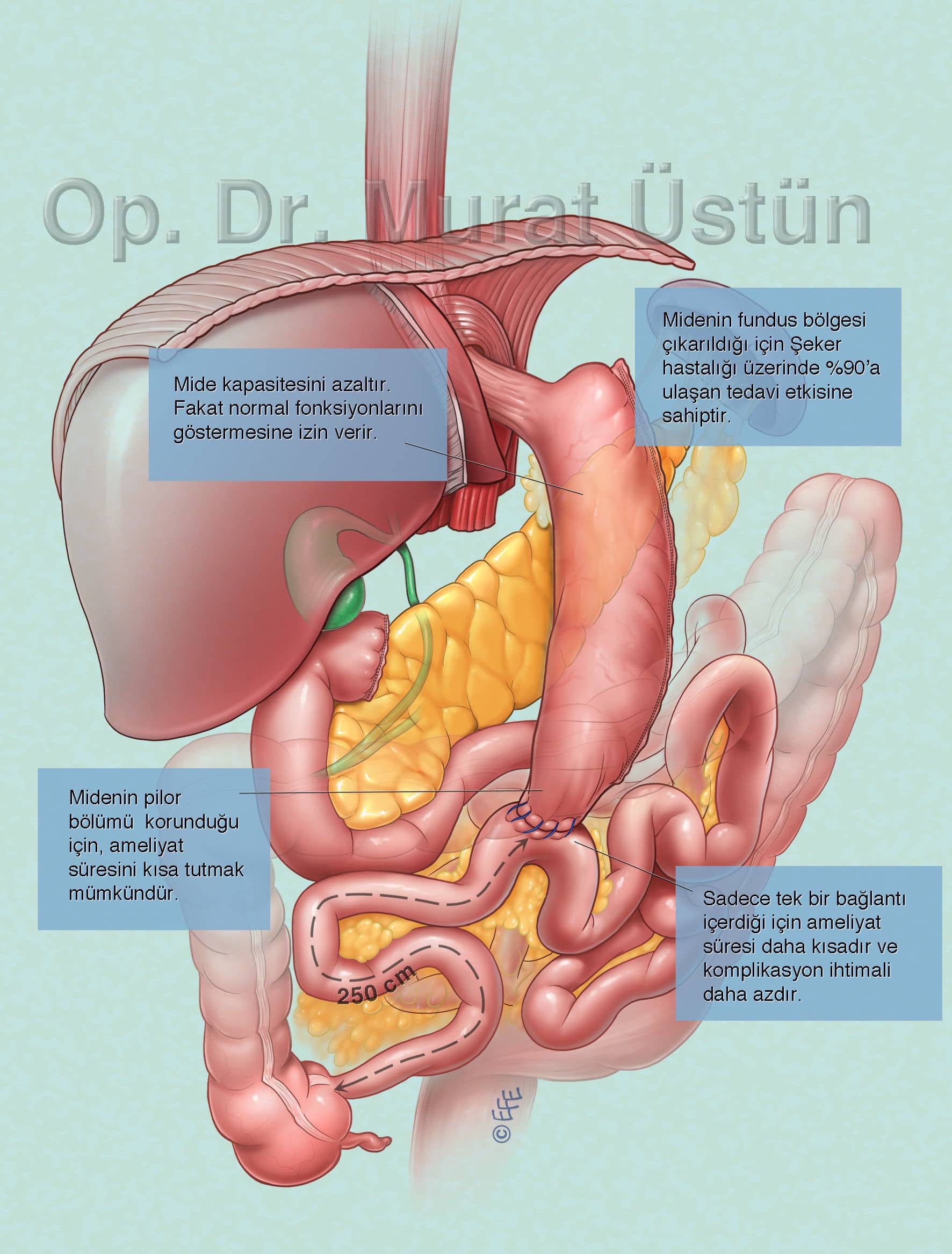 Duodenal Switch (DS) Surgery 2