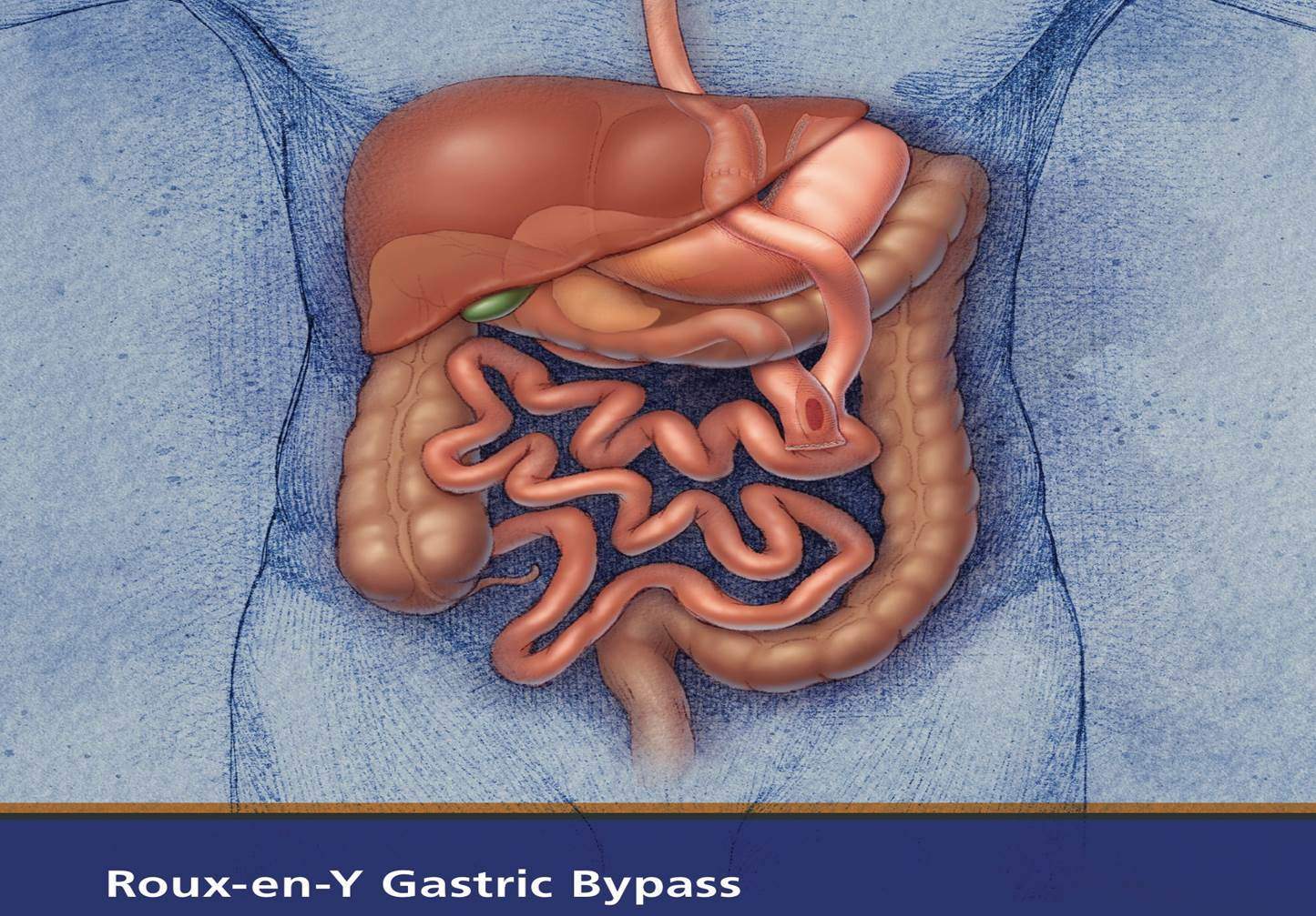 Gastrik Bypass Ameliyatı Komplikasyonları Nelerdir? 1