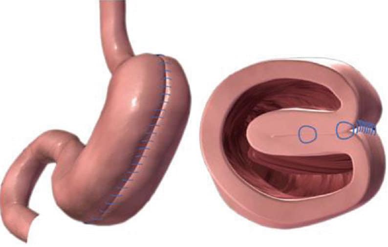 Laparoscopic Gastric Plication Op Dr Murat Üstün