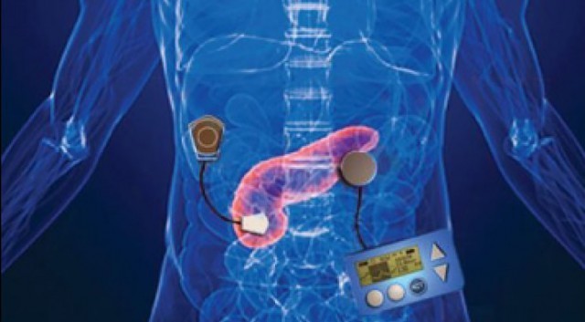Yapay Pankreas Cihazı FDA Onayı Aldı! 1