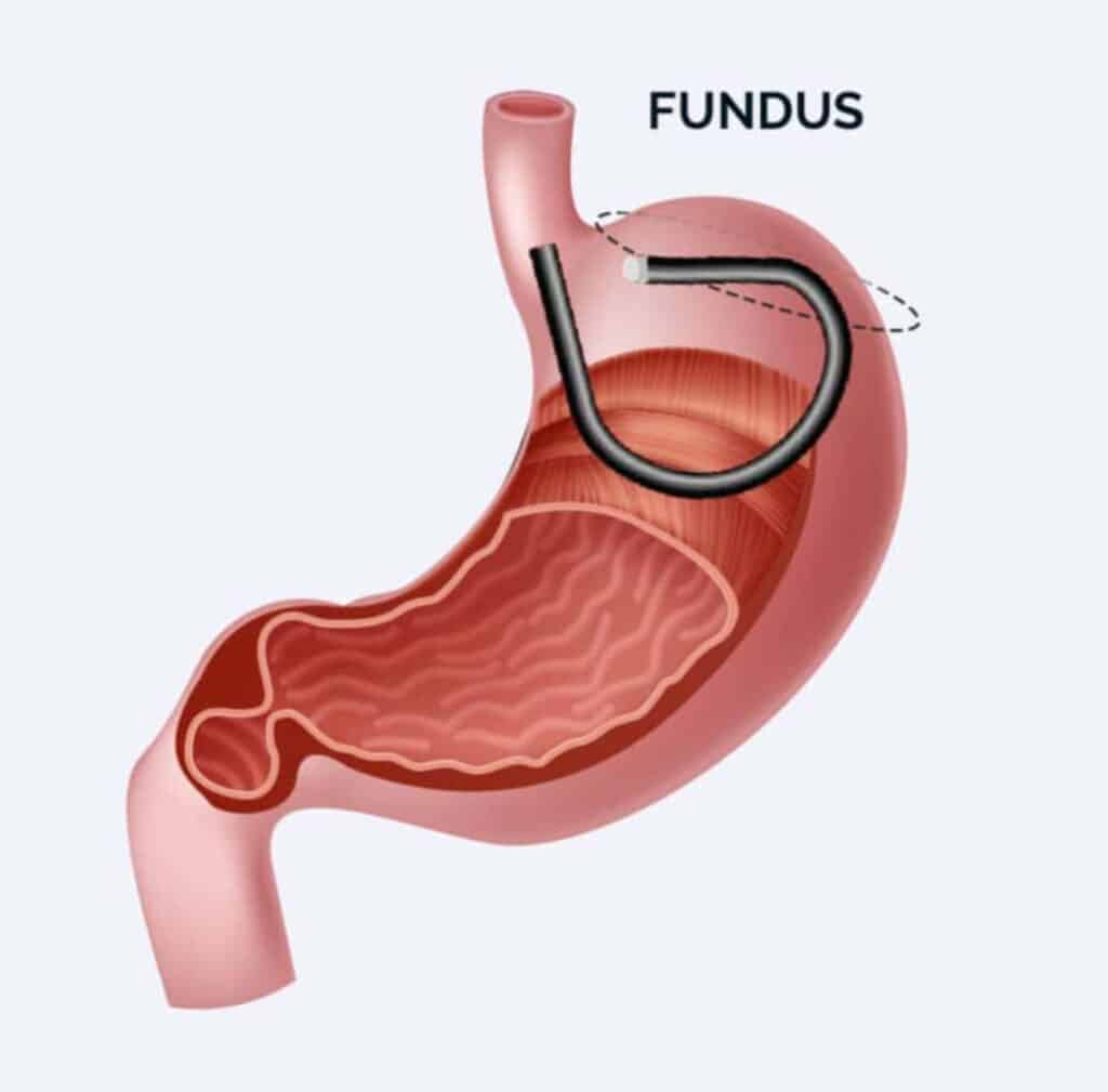 Mide Fundus Ablasyonu (Mide Lazeri) Nedir? 4