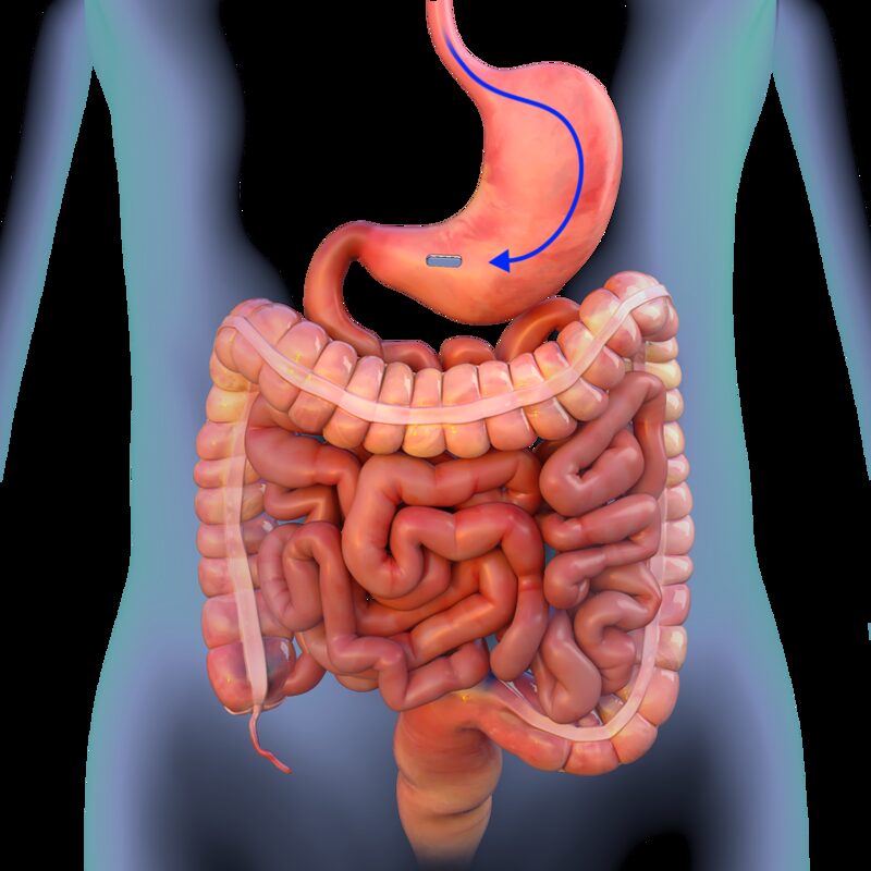 Manyetik Bypass Manyetik Bypass