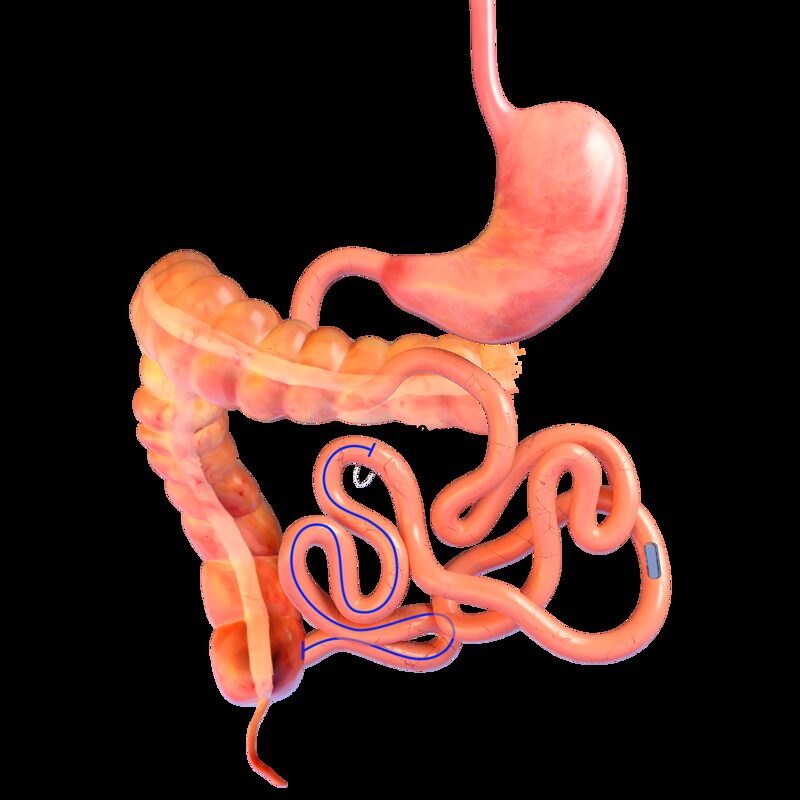 Manyetik Duodenoileal Bypass Manyetik Duodenoileal Bypass