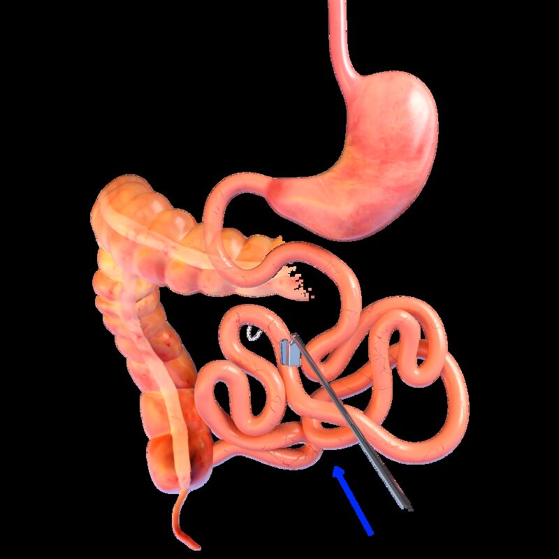 Endoskopik laparoskopik cerrahi Endoskopik laparoskopik cerrahi