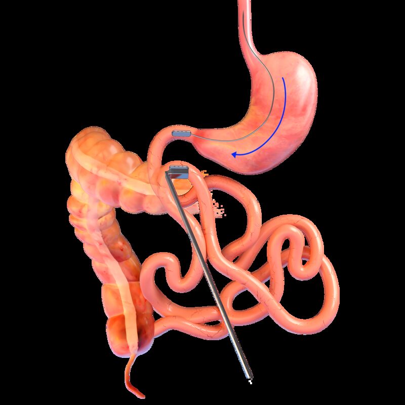 Manyetik metabolik cerrahi Manyetik metabolik cerrahi