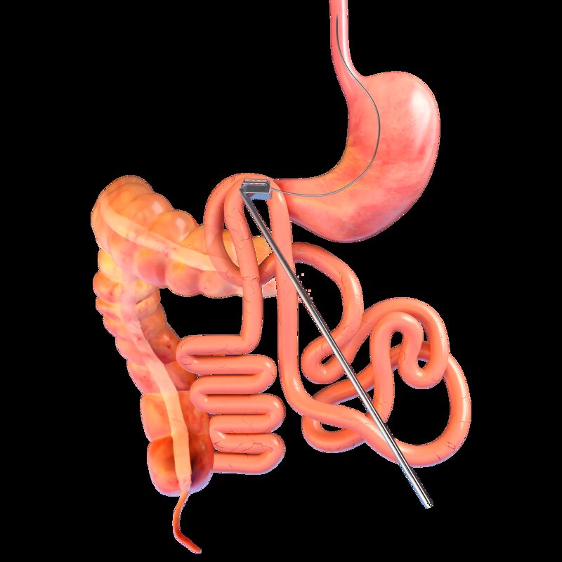 Magnetik Bypass Magnetik Bypass