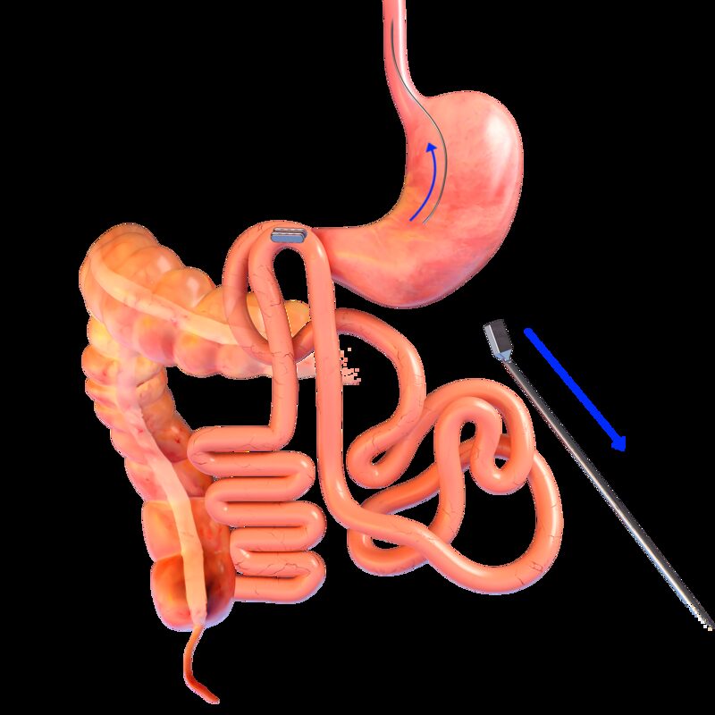 Magnetik Metabolik Cerrahi Magnetik Metabolik Cerrahi