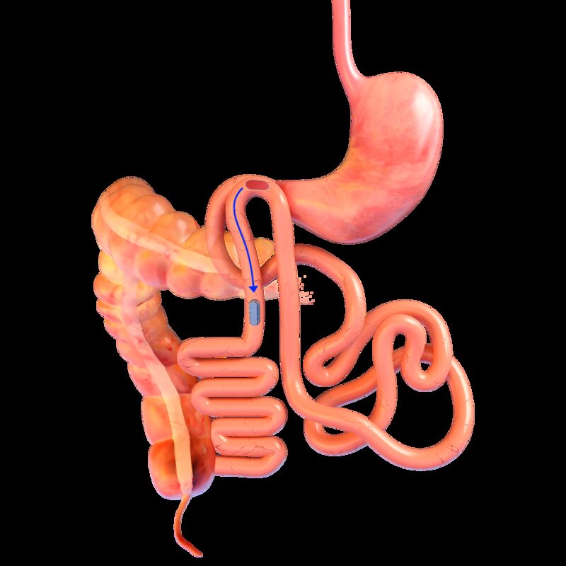 Mıknatıslı anastomoz Mıknatıslı anastomoz