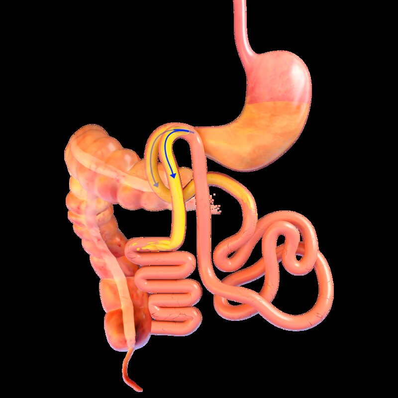 Mıknatıslı Bypass Mıknatıslı Bypass